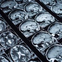 Can a Side-Swipe Crash Cause a Traumatic Brain Injury?